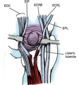 Ganglion Cyst Handout Dr Thomas Trumble M D