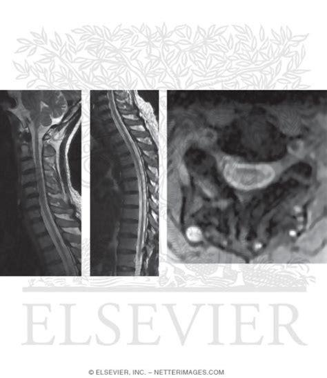 Neuromyelitis Optica