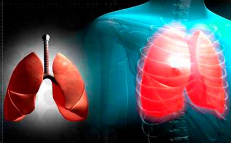 Programa De Trasplante Pulmonar Fondo Nacional De Recursos