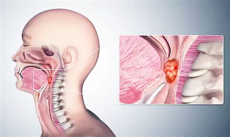 Oral Sex Is Now The Leading Risk Factor For Throat Cancer The Namibian