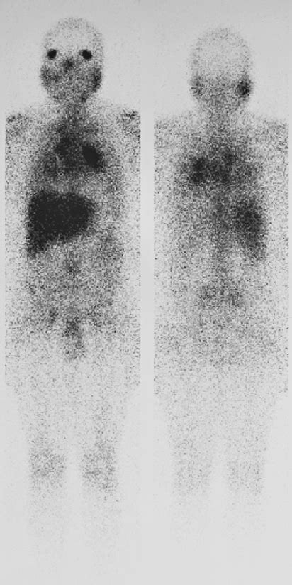 Gallium 67 scan, showing uptake in lungs, mediastinum, orbits and ...