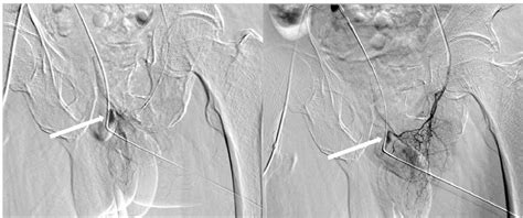 Pdf Two Artery Embolizations For Severe Hematuria After Transrectal