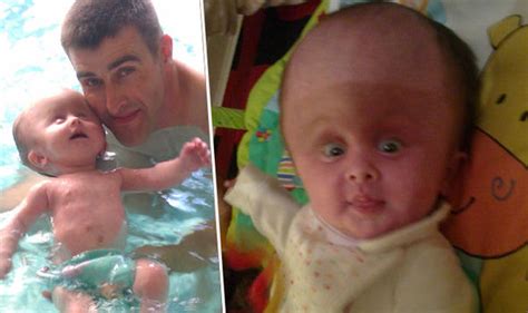 Baby with rare condition born with ADULT-SIZED head | Life | Life ...