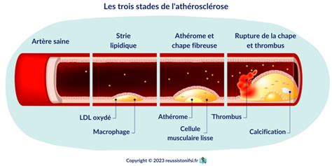 Prise en charge de l infarctus du myocarde Réussis ton IFSI