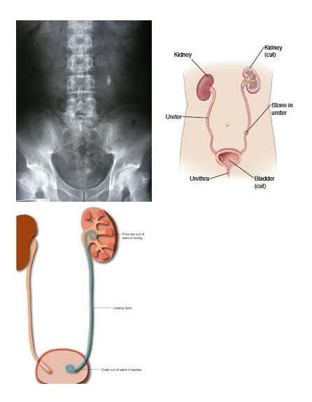 Surgical Treatment for Ureteric Stones in Chennai | Dr. Rela Institute ...