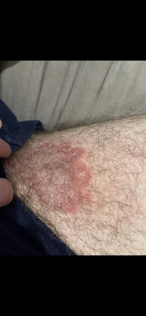 Can Anyone Identify This Rash In My Inner Thigh Groin Area Could It Be Fungal 28m R