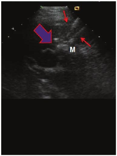 The Process Of Percutaneous Ethanol Injection Figure 2 The Process Of