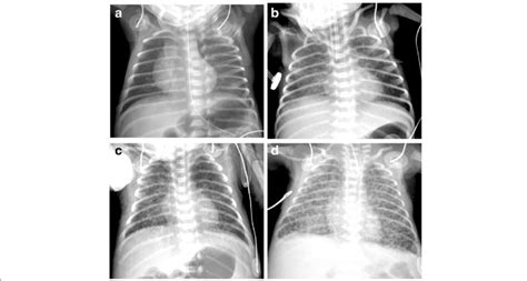 Chest Radiographs Representing Each Grade A No Demonstrable