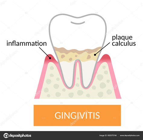 Gingivitis Tooth Gums Plaque Calculus Build Gums Inflamed Dental Oral