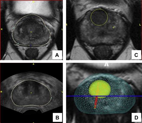 Targeted MRI Guided Prostate Biopsies For The Detection Of Prostate