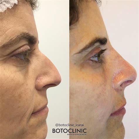 Botoclinic Icaraí On Instagram Você Já Ouviu Falar Em RinomodelaÇÃo