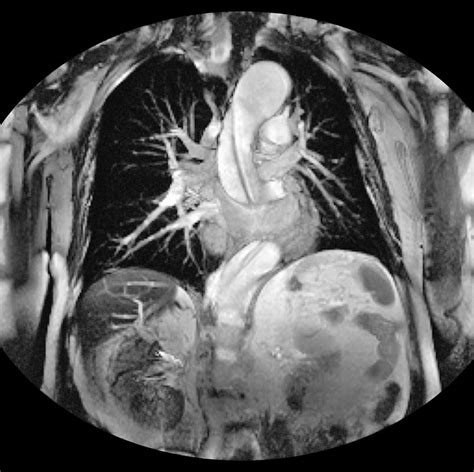 Dissecting Aorta Mri Scan Photograph By Du Cane Medical Imaging Ltd