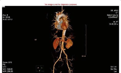 3D CT aortography reconstruction 6 months after the procedure: Blood ...