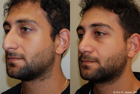 Eric M Joseph Md Rhinoplasty Before And After 3 Months After Male