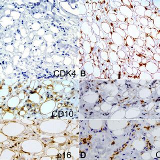 Photomicrographs Of The Surgical Specimen Immunohistochemical Analysis