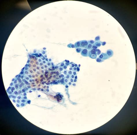 Cytology Bile Duct Stricture Brushing Pap Stain Malignant