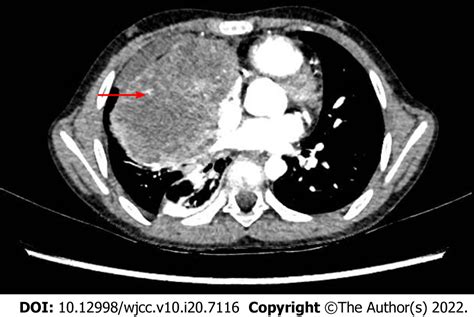 Malignant Histiocytosis Associated With Mediastinal Germ Cell Tumor A