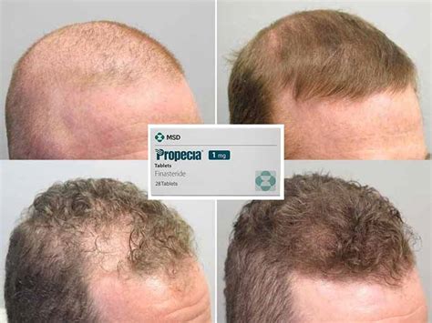 Finasteride For Hair Loss - Is It A Viable Solution? - Laylahair