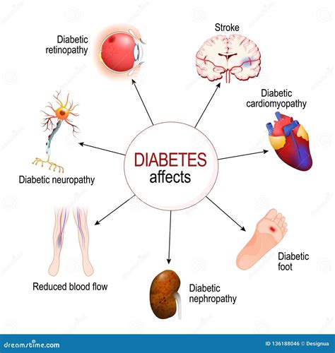 Diabetes Affects Complications Of Diabetes Mellitus Stock Vector