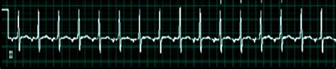 Figure Atrial Tachycardia Image Courtesy Dr Chaigasame Statpearls