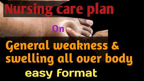 Nursing Crae Plan On General Weakness And Swelling Of All Over Body Ncp