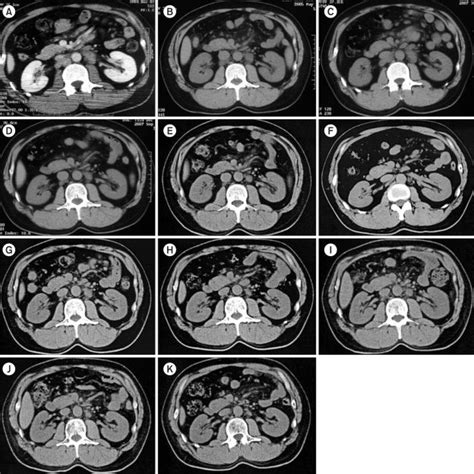 Computed Tomography A Contrast Enhanced Abdominal Computed