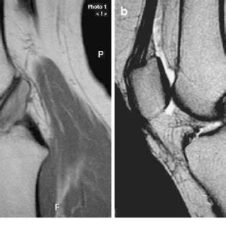 a Sagittal T1 view of the ACL by MRI. Mucoid degeneration of the lower... | Download Scientific ...