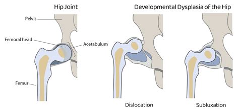 Developmental Dysplasia of the Hip (DDH) | Gillette Children's