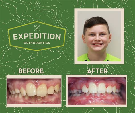 Orthodontic Before and After Photos | Expedition Pediatric Dentistry