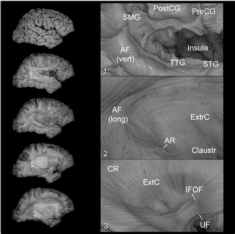 Klingler Dissection Of The Arcuate Fasciculus As An Illustration The