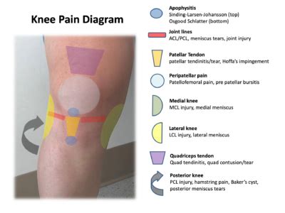 Knee And Leg Pain Diagnosis Chart | Hot Sex Picture