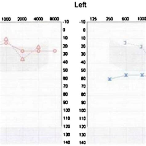 Audiogram demonstrating left moderate-severe conductive hearing loss ...