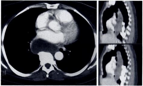 Achalasia in a 52-year-old woman. Spiral CT scan (a) and sagittal ...