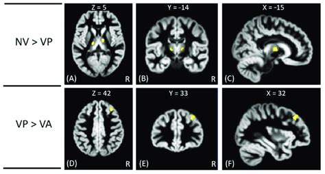 The Vbm Analysis Of Gm Volume Between The Vp Va And Nv Groups The