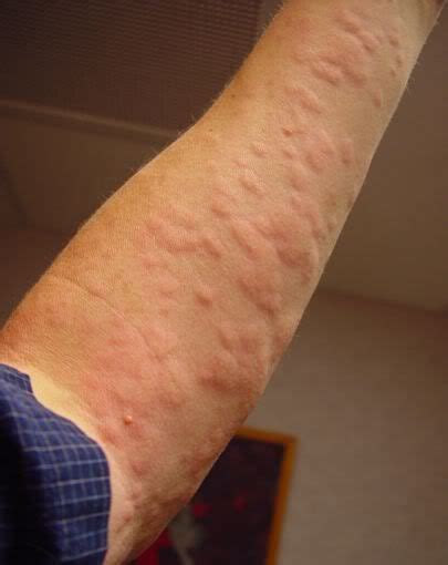 How can you cure chronic hives? - Hives News | Chronic hives, Stress ...