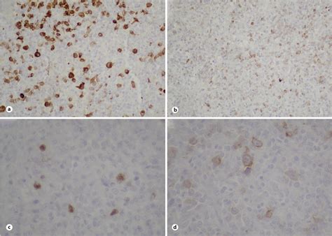 Figure 2 From Splenic Micronodular T Cell Histiocyte Rich Large B Cell Lymphoma Semantic Scholar