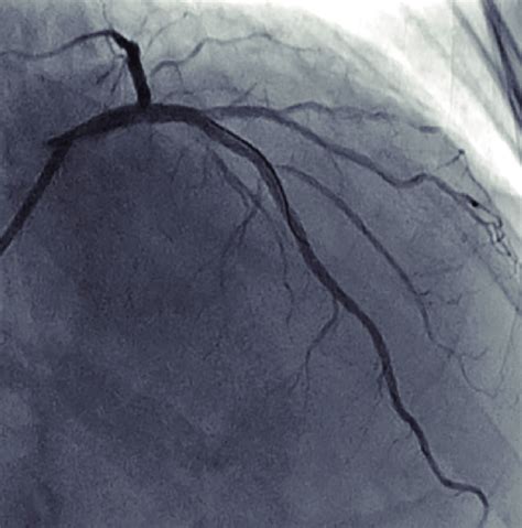 Final Result The Final Angiogram Showed Fully Expanded Left Anterior