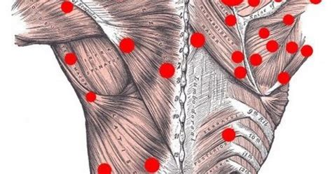 Puntos gatillo qué son y cómo se tratan Fisioterapia Cranium