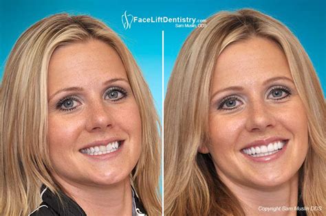 No Prep Porcelain Veneers To Widen Smile