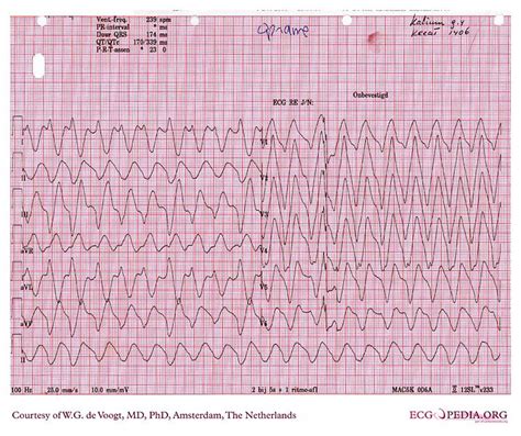Pulseless electrical activity electrocardiogram - wikidoc