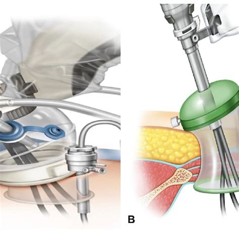 Single Port Transperineal Robot Assisted Radical Prostatectomy An