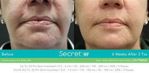 Microneedling With Secret Rf And Collagen Pin Memphis Laser Clinic Cordova Tn