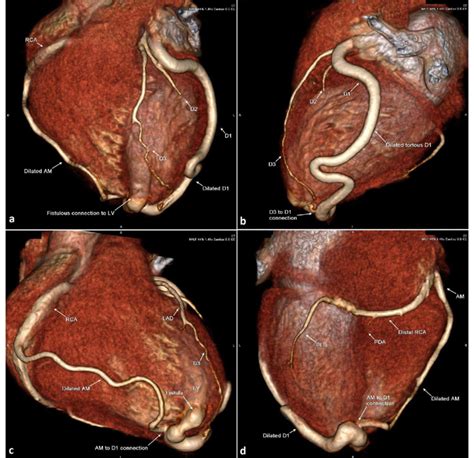 Large First Diagonal Branch Coronary Artery Fistula With Lv Apex In