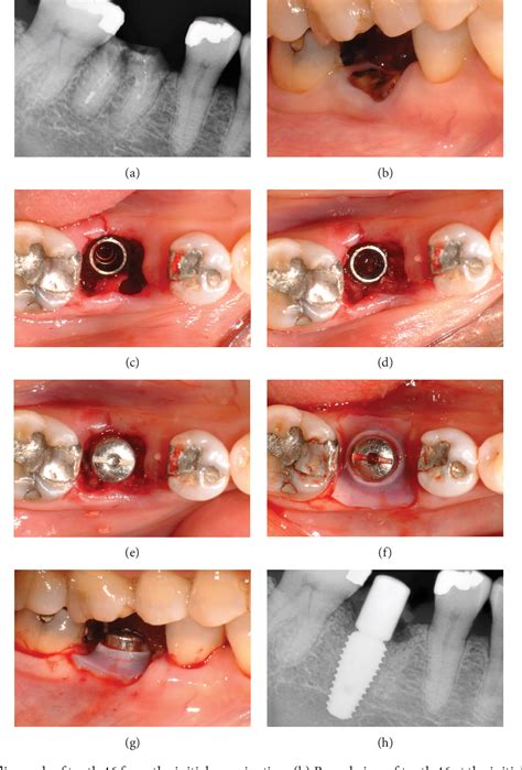 Figure 2 From Novel Use Of Silicone Sheets For Immediate Implant