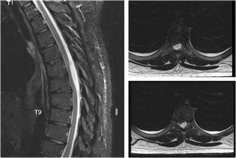 A Sagittal T2 Weighted And Corresponding Axial Cross Sections At Two