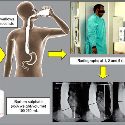 Technique of timed barium esophagogram. Barium sulphate suspension (45% ...