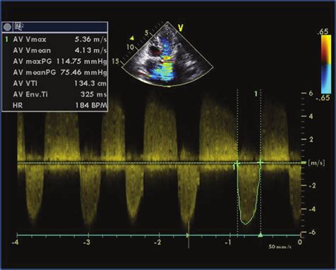 Echocardiogram Aortic Stenosis