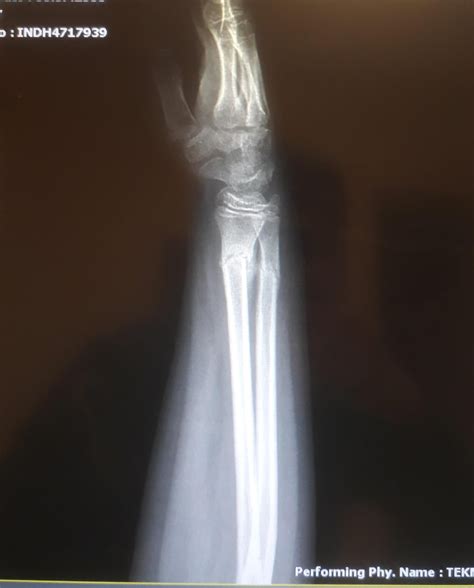 forearm fracture : r/Radiology