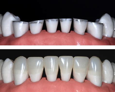 Lab Simulations Metal Ceramic Pfm Crown Prep Upper 1st Premolar