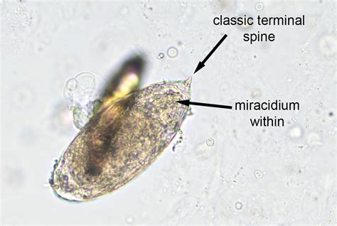 Pathology Outlines Schistosomiasis